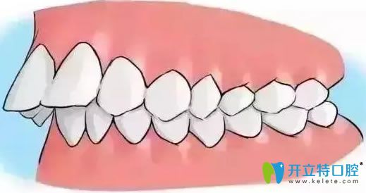 聽說門牙突出能自我糾正,牙齒外突可以用手按回去嗎？