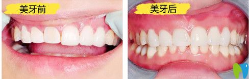東莞好佰年口腔全瓷牙修復(fù)案例