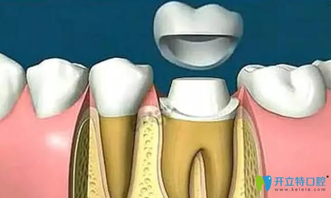 牙齒開裂該如何治療