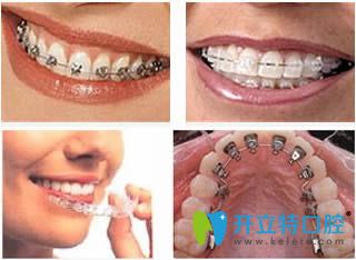 各種矯正器種類圖