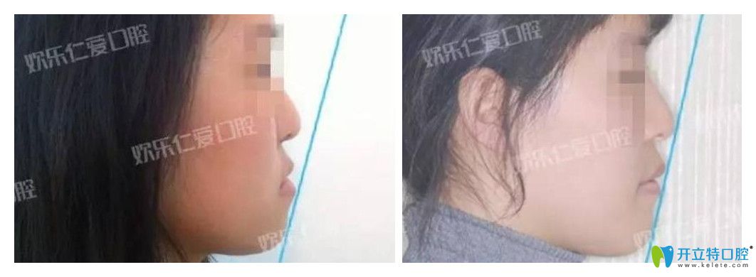 沈陽(yáng)歡樂(lè)口腔怎么樣？肖春正畸案例公布