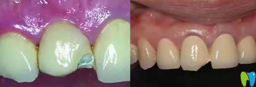 烤瓷牙崩瓷了怎么辦?真相烤瓷牙壞了能不能修復及有沒有毒