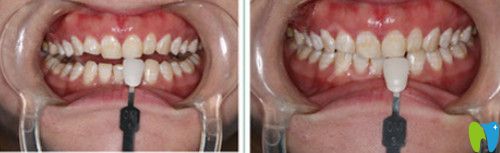 瓷貼面前牙齒情況 瓷貼面前牙齒情況