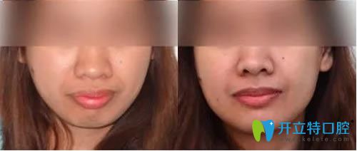 廣州壹加壹蘇文新院長成人自鎖托槽矯正對比效果