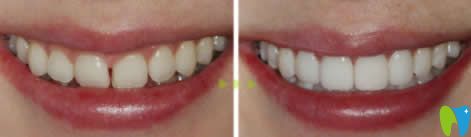 長春陳北松口腔陳北松醫(yī)生牙齒貼面案例