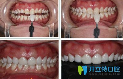 全瓷貼面牙齒前后對比圖 全瓷貼面牙齒前后對比圖