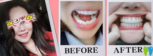 東莞哪里矯正牙齒好？東莞好百年口腔牙齒不齊矯正案例來證明
