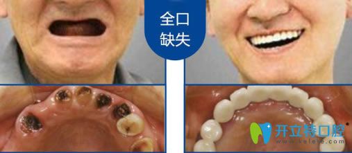深圳諾德齒科鮑立峰全口種植牙真實(shí)案例圖
