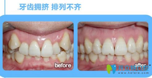 深圳諾德文梁醫(yī)生牙齒擁擠矯正前后對比效果