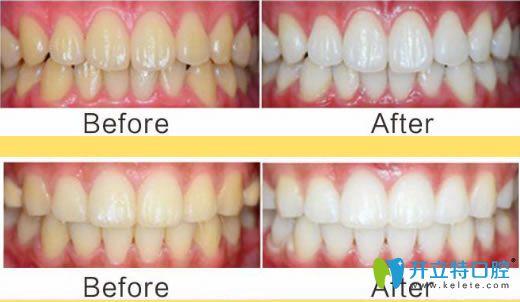 諾德齒科成人洗牙前后對比效果