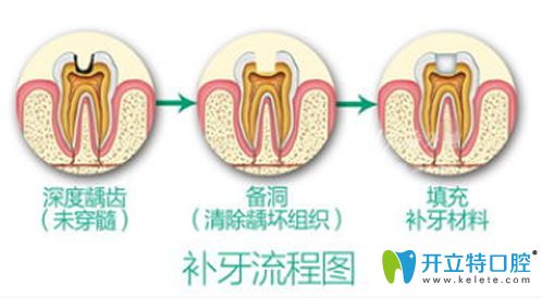 牙齒做根管治療和補(bǔ)牙有什么區(qū)別