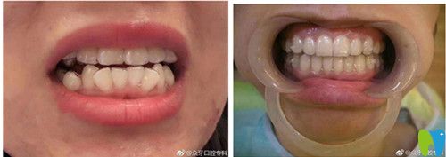 太原眾牙口腔隱形牙齒矯正效果圖