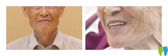 張尚堅(jiān)為60歲老伯做全口牙種植案例