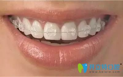 美國(guó)3M牙套和普通牙套區(qū)別和價(jià)格匯總