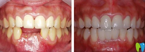 北極星口腔種植牙前后對比圖 北極星口腔種植牙前后對比圖