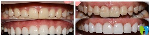 太原眾牙口腔瓷貼面前后變化圖