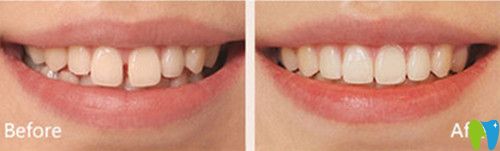 美奧口腔好不好？看杭州美奧瓷貼面變化圖