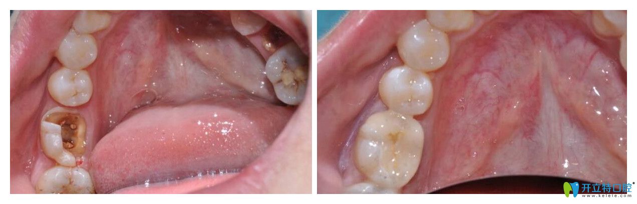 曹雪后牙瓷睿刻修復(fù)案例