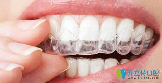隱形牙套的圖片