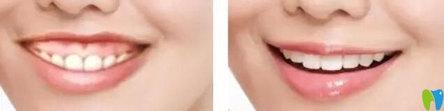 露齦笑矯正前后對比照片