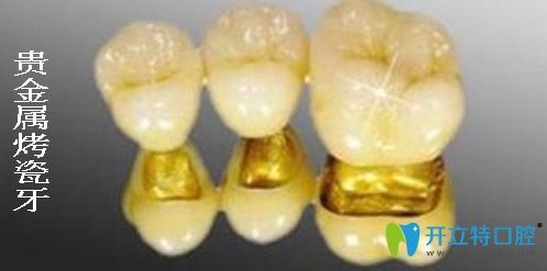 貴金屬烤瓷牙
