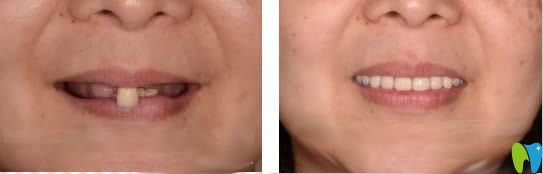 杭州美奧allon4全口種植牙真實(shí)案例