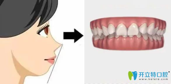 牙齒深覆頜臉型圖解