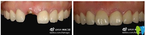 美奧口腔種植牙前后對比圖