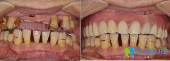 美奧口腔ALL-ON-4半口種植牙前后對(duì)比效果