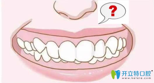 深覆頜矯正的價格需要多少錢