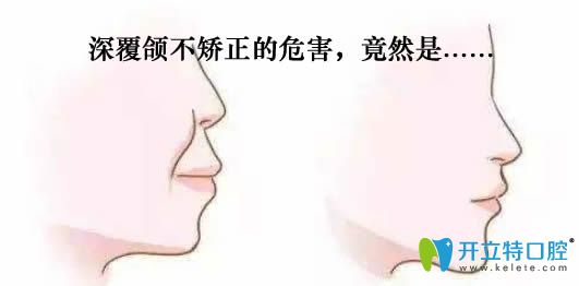 深覆頜不矯正的危害