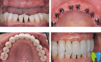 寧波牙博士口腔郝義身醫(yī)生全口種植牙案例 寧波牙博士口腔郝義身醫(yī)生全口種植牙案例