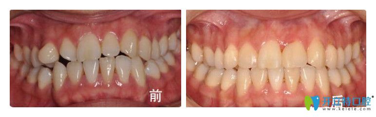 諾德齒科曹雪怎么樣？真人案例效果來證明實力