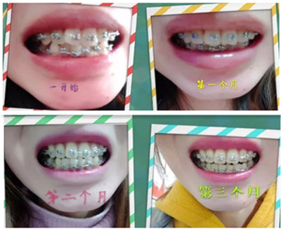 云南華美美萊口腔做正畸三個(gè)月的變化過程