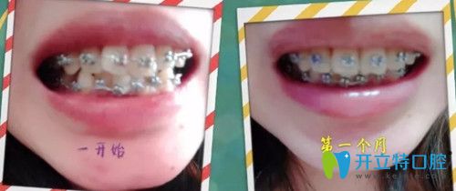 第1天~第30天帶牙套變化圖