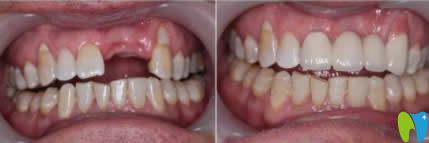 寧波牙博士口腔張春旭種植牙案例