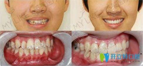 20歲顧客齙牙矯正前后對比案例