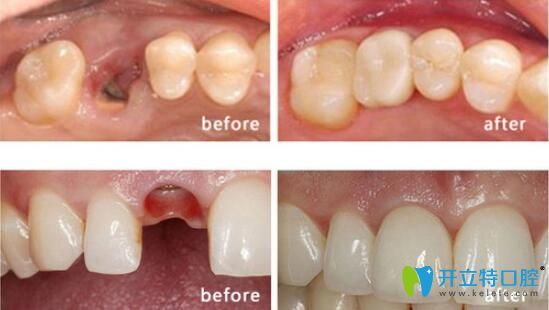 諾德齒科怎么樣？文梁種植牙案例效果驗證