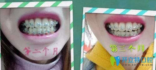 第60天~第90天牙齒已經(jīng)逐漸排齊