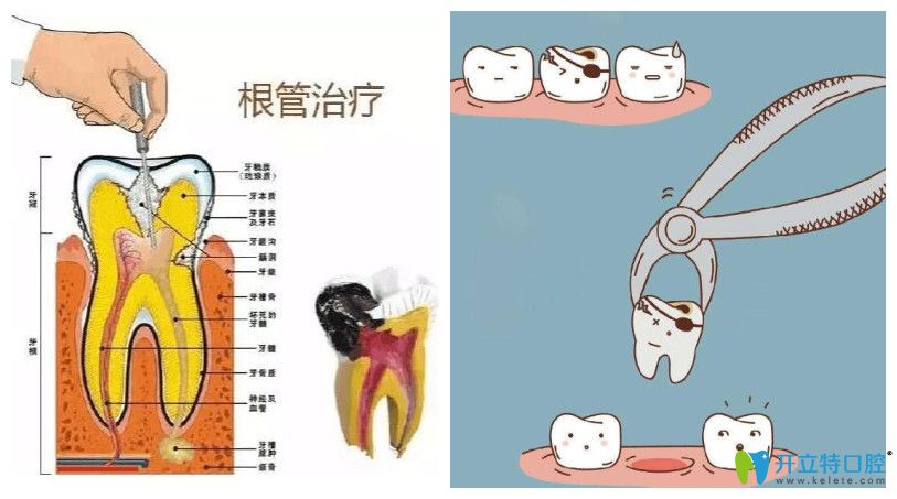 根管治療和拔牙有什么區(qū)別