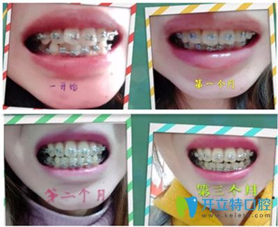 牙齒矯正第1天~第90天效果圖