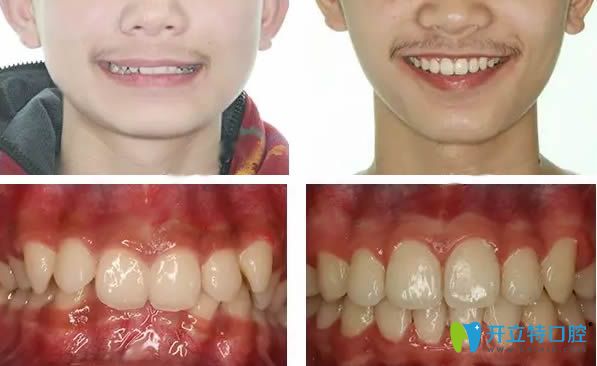 重慶維樂牙科深覆合矯正后下巴變化對比圖