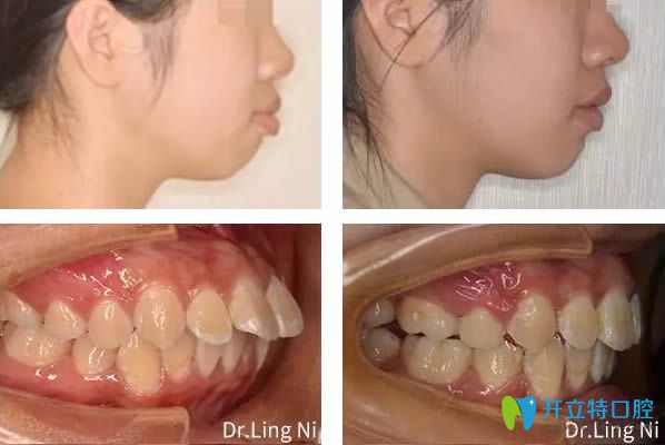 深覆蓋正畸案例見證重慶維樂口腔矯正如何