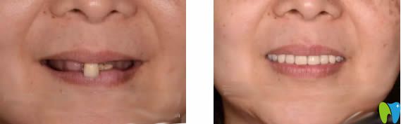 武漢清華陽(yáng)光口腔3D導(dǎo)板種植牙前后對(duì)比效果