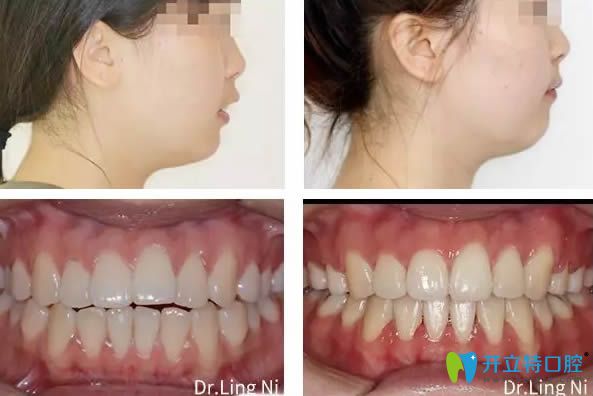 重慶維樂口腔深覆蓋矯正前后臉型效果圖