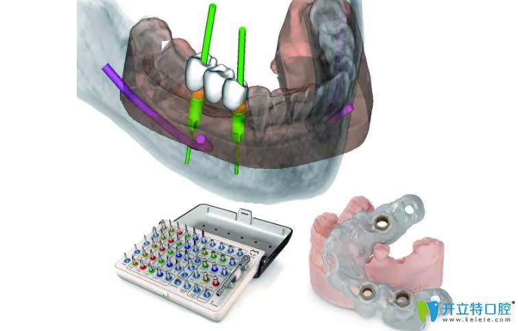 3d導(dǎo)板定位種植技術(shù)優(yōu)勢(shì)