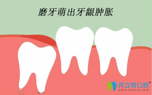 兒童長(zhǎng)磨牙牙齦腫破需要怎么處理嗎？