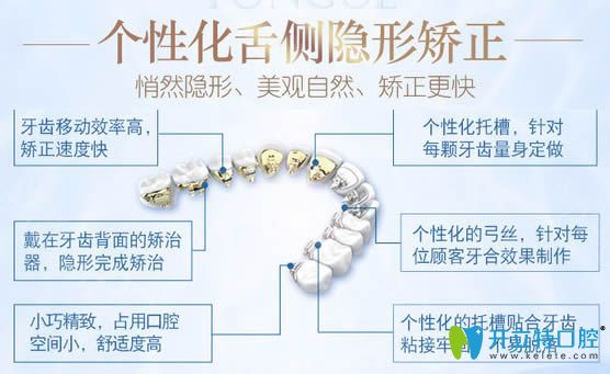 舌側(cè)矯正具有矯正速度快等優(yōu)勢