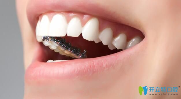 什么是舌側(cè)隱形正畸