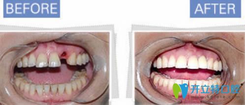 西安諾貝爾單顆牙缺失案例對比效果圖